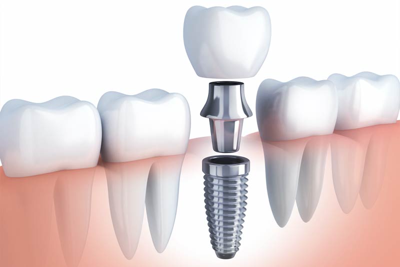 Implants Dentist in Bellaire