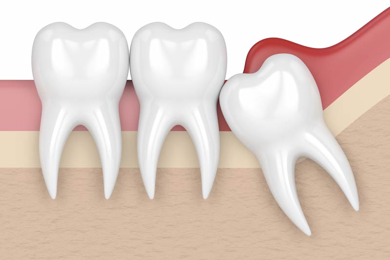 Wisdom Tooth Removal in Bellaire